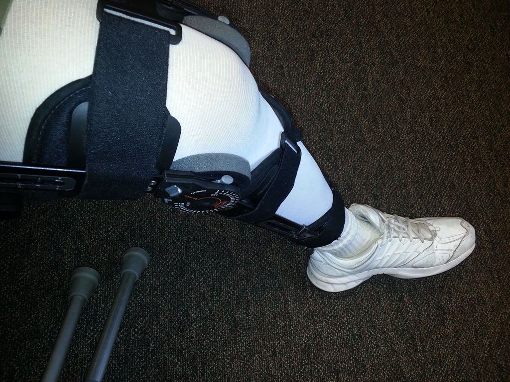 My broken leg during the rifle deer hunt.